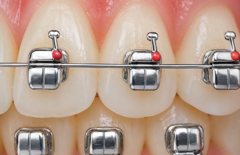 Curve Self-Ligating Brackets